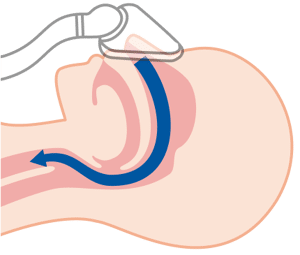 CPAPにより閉塞を防ぐ