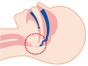 閉塞している喉の状態